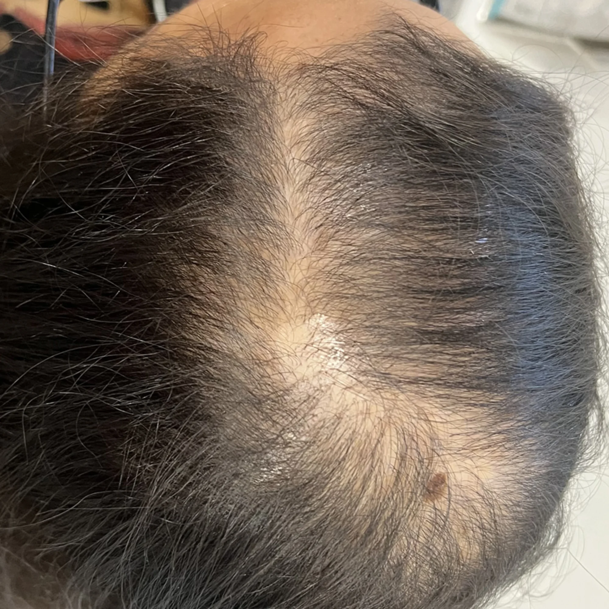 Before Scalp Micropigmentation