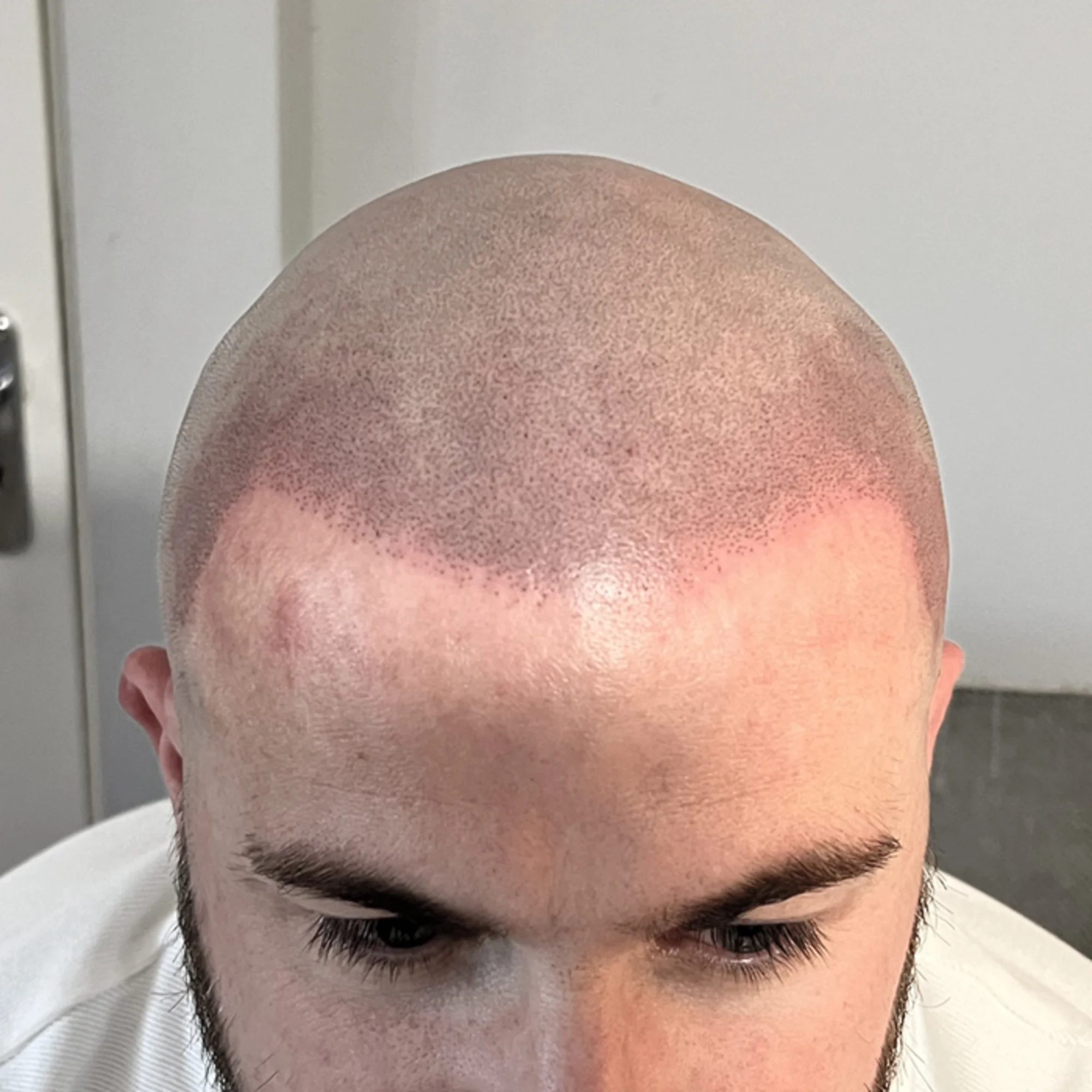 After Scalp Micropigmentation