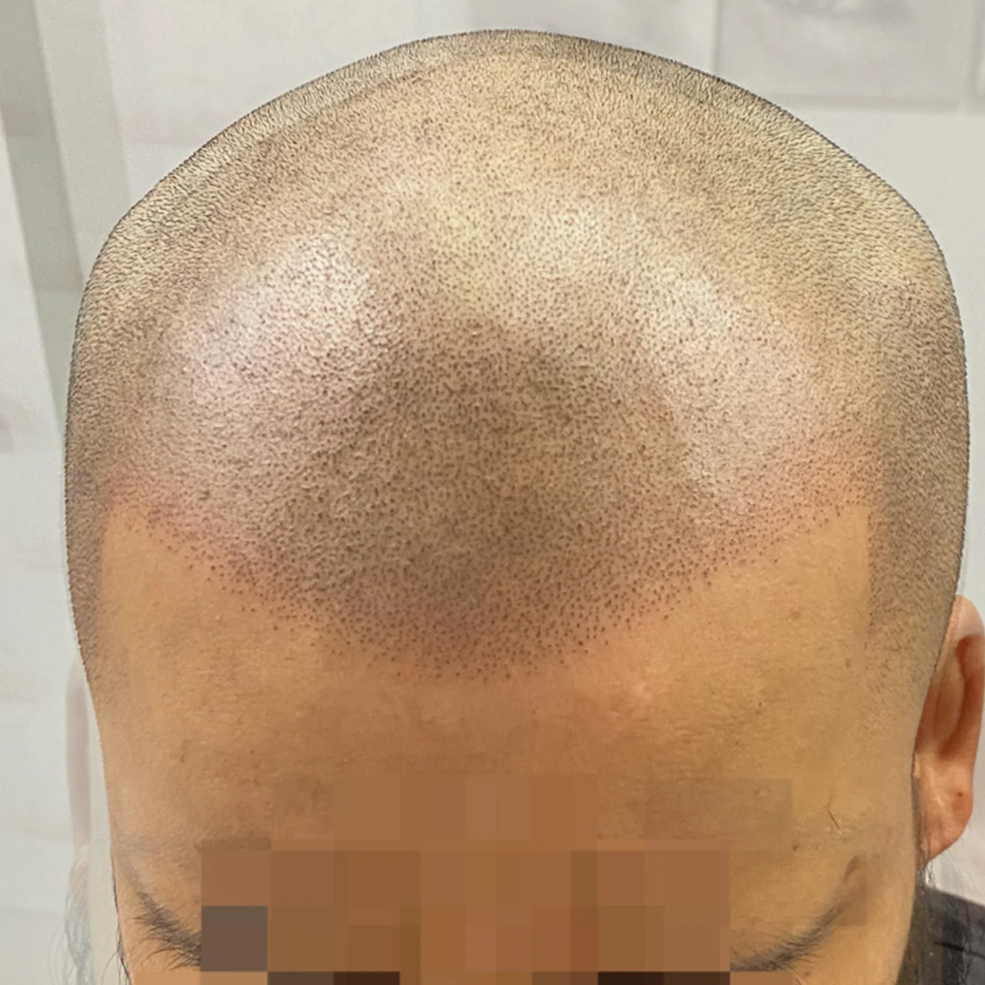 After Scalp Micropigmentation