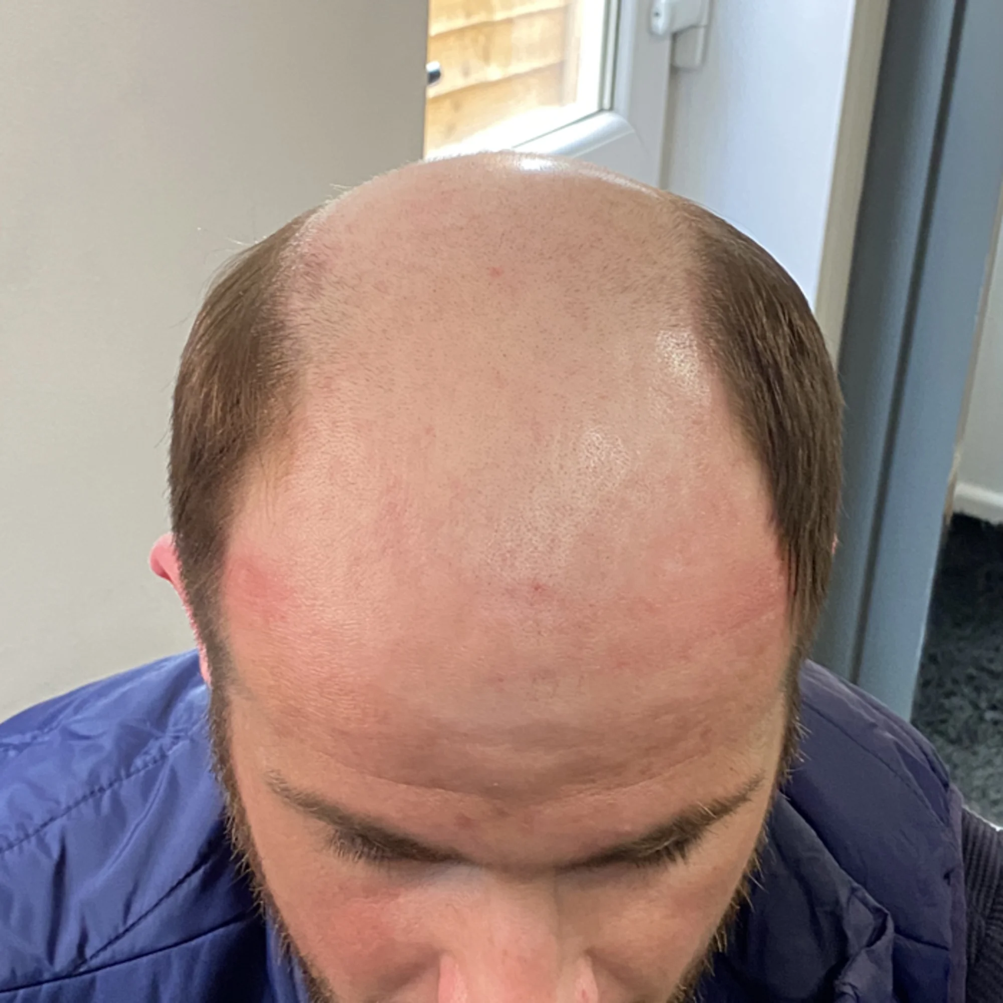 Before Scalp Micropigmentation