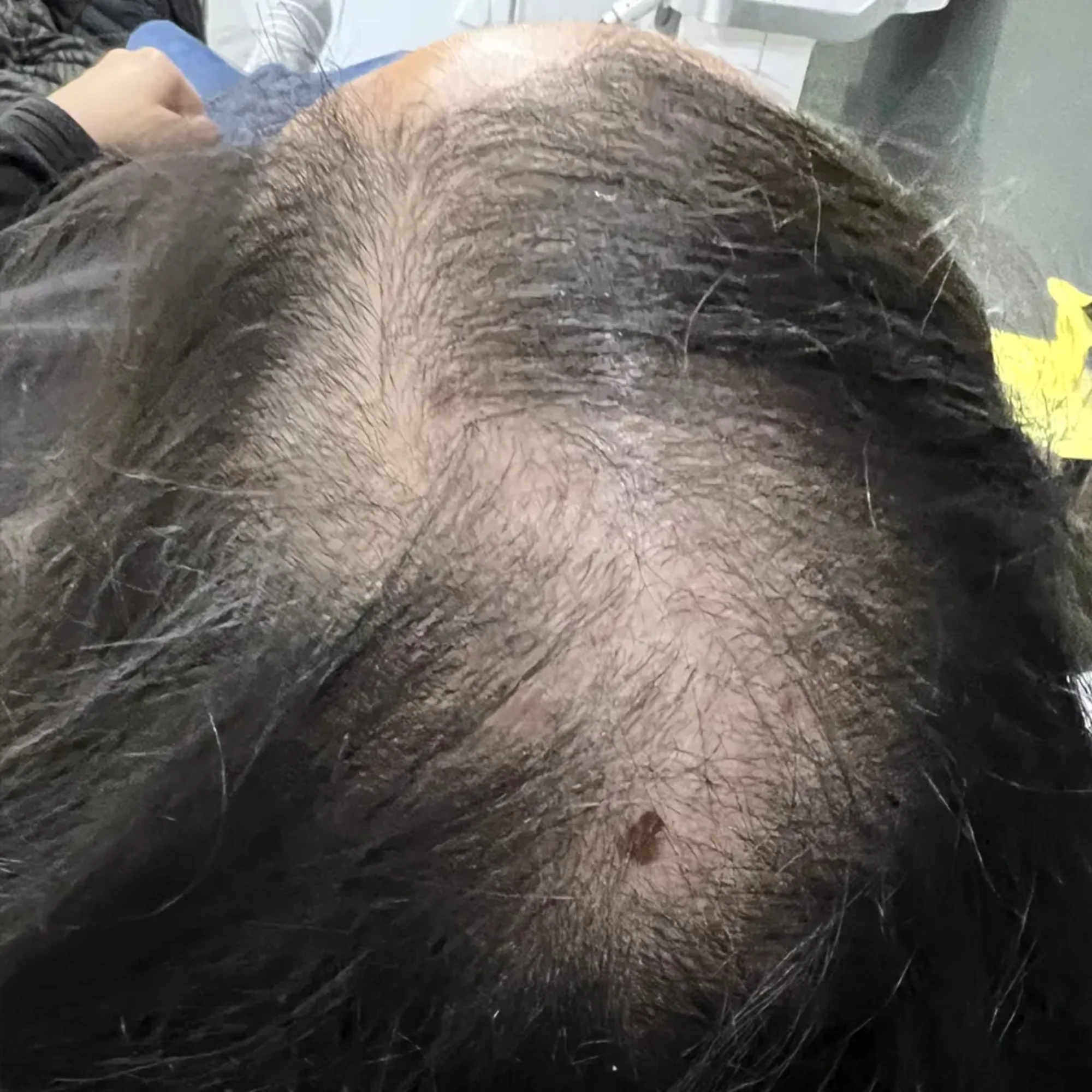 Before Scalp Micropigmentation