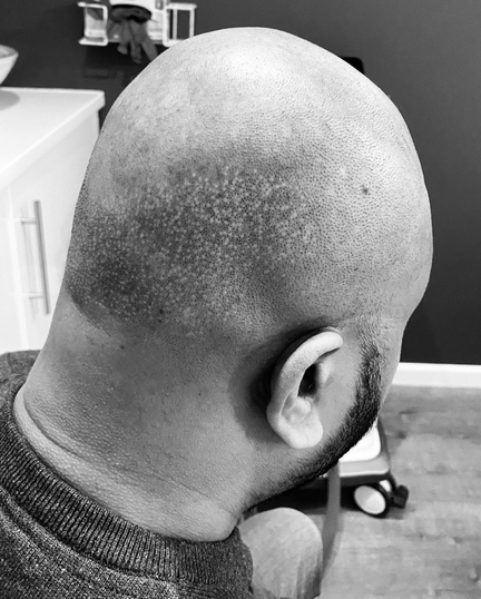 SCALP TATTOOING & CAMOUFLAGE OF SCARRING Milton Keynes