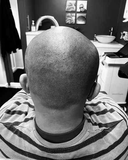 SCALP TATTOOING & CAMOUFLAGE OF SCARRING Milton Keynes