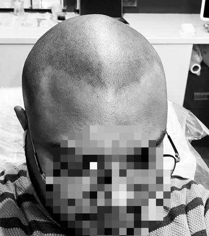 SCALP TATTOOING & CAMOUFLAGE OF SCARRING Milton Keynes