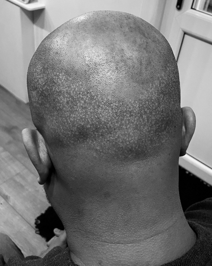 SCALP TATTOOING & CAMOUFLAGE OF SCARRING Milton Keynes