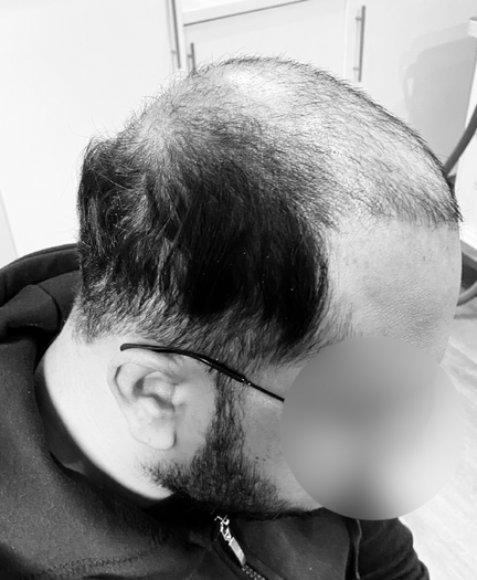 SCALP TATTOOING & CAMOUFLAGE OF SCARRING Milton Keynes