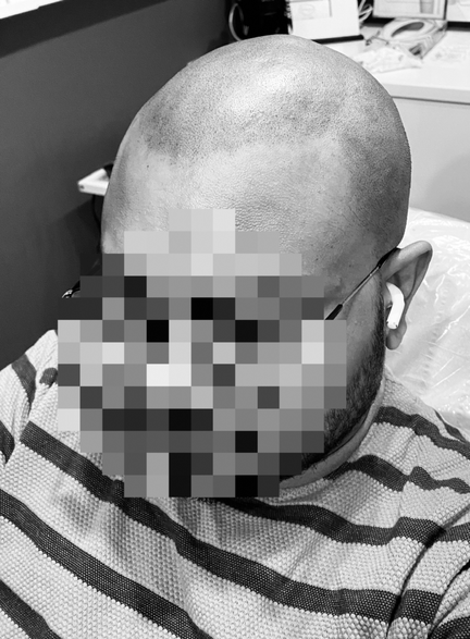 SCALP TATTOOING & CAMOUFLAGE OF SCARRING Milton Keynes