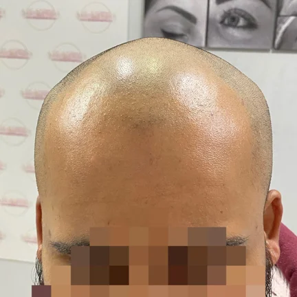 Scalp Micropigmentation