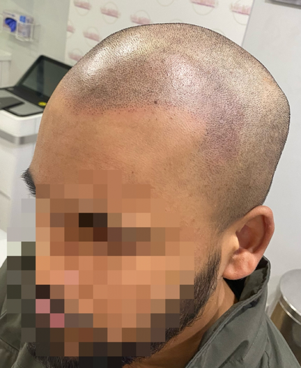Scalp Micropigmentation