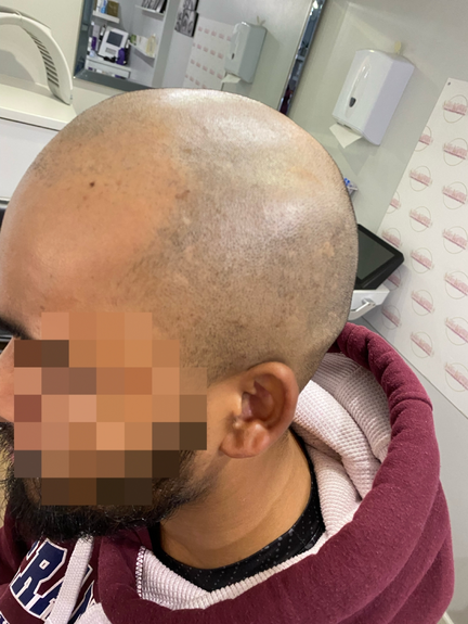 Scalp Micropigmentation