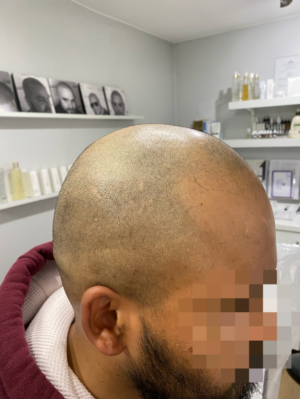 Scalp Micropigmentation