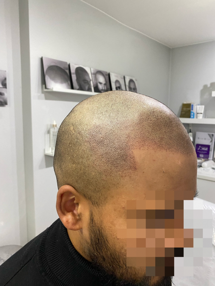 Scalp Micropigmentation