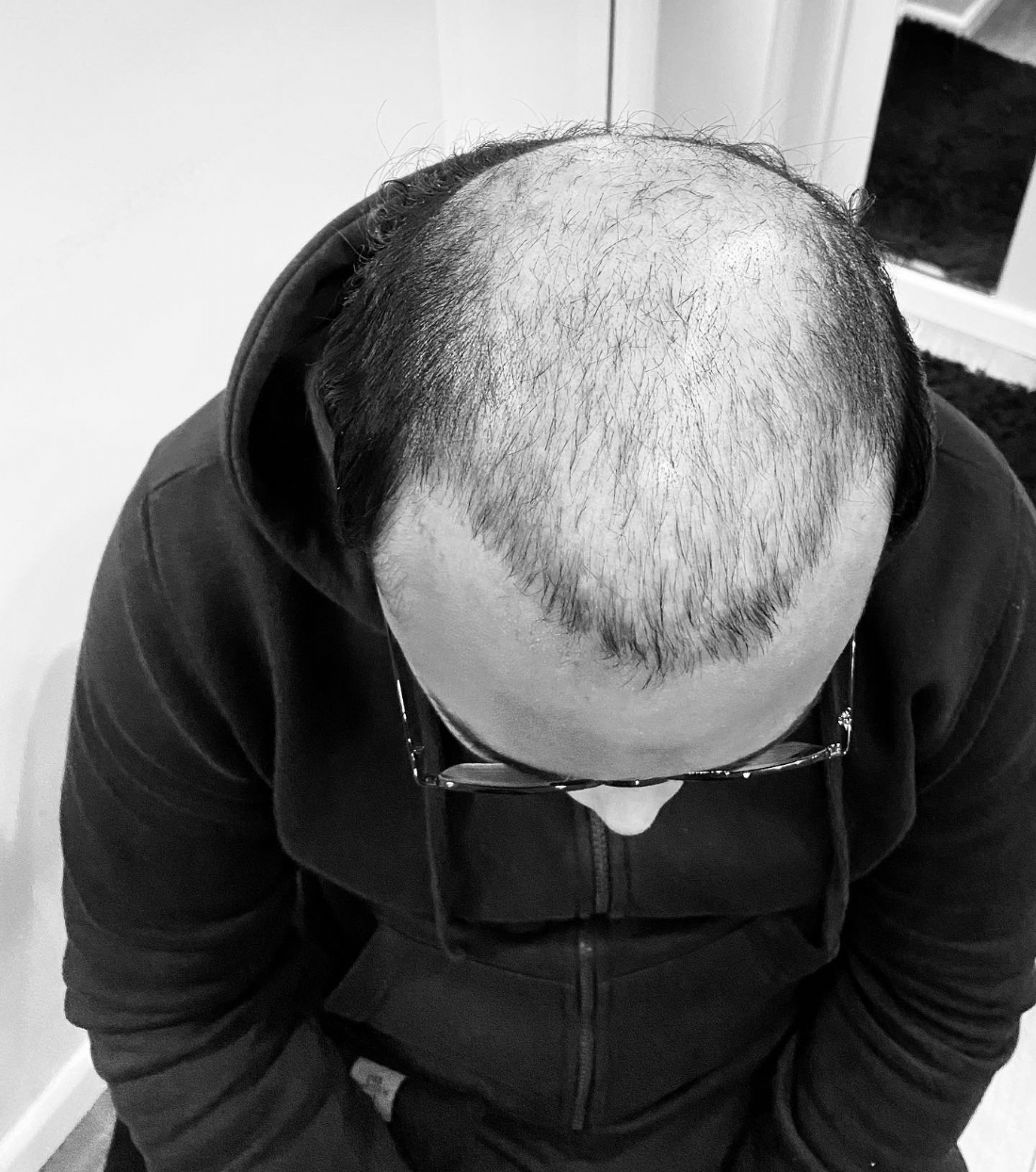 SCALP TATTOOING & CAMOUFLAGE OF SCARRING Milton Keynes