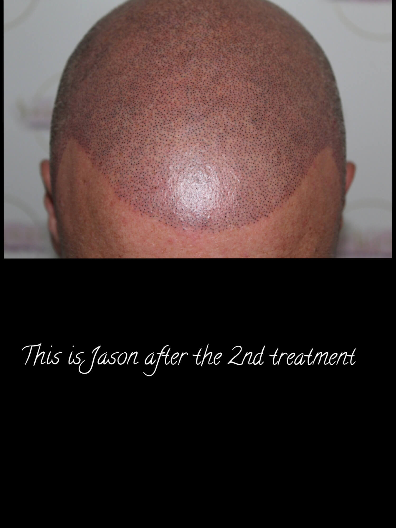 before & affter scalp tattoo