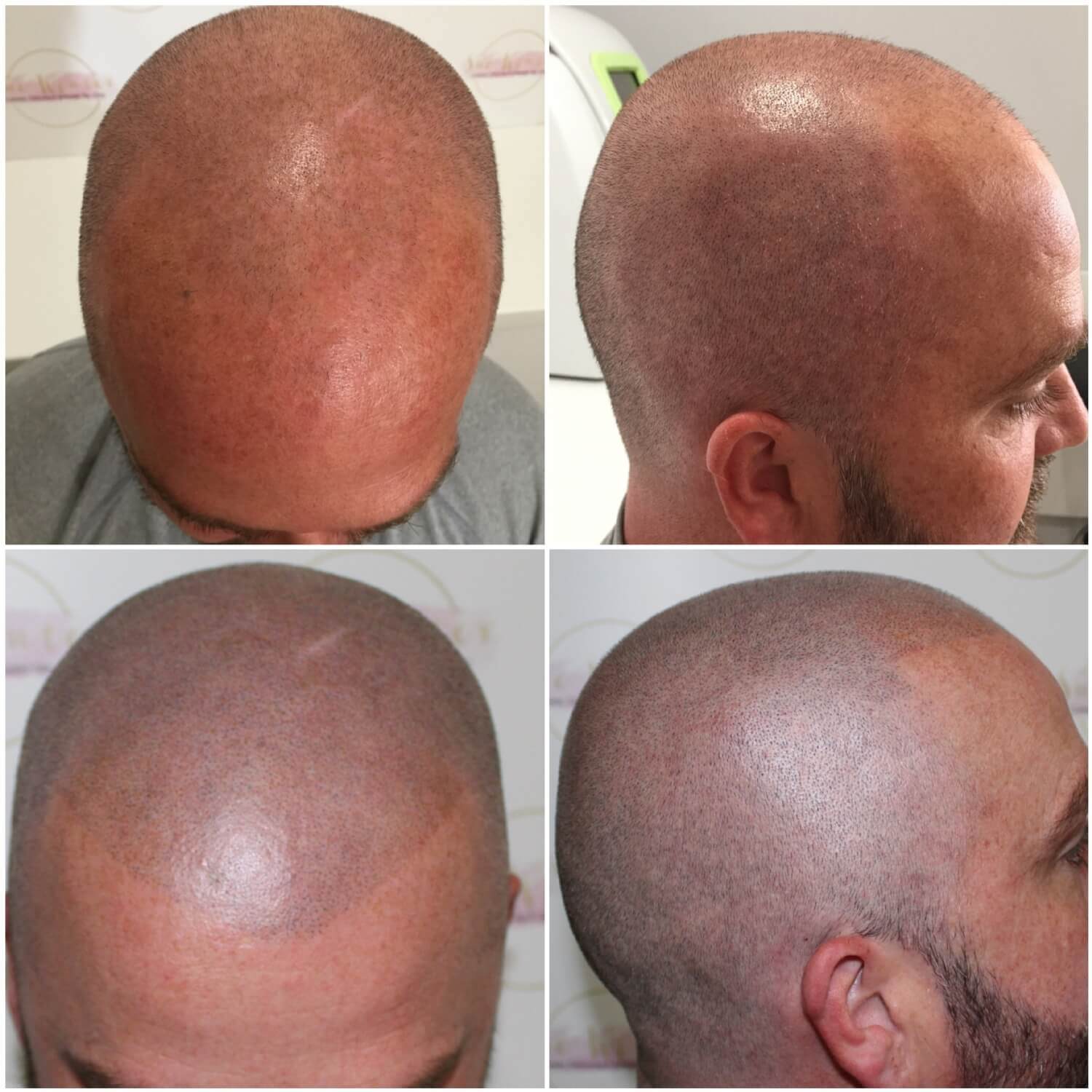 before & affter scalp tattoo